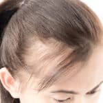 Is Exosome Treatment The Future Of Hair Restoration? Here’s What Experts Say