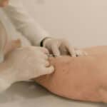 Is Sclerotherapy Painful? What Patients Say About the Experience