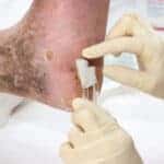 Treating a Diabetic Foot Ulcer