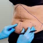 Types of Tummy Tuck and What Each One Is Actually Built For