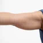 Signs an Arm Lift May Be the Right Solution for Loose Arm Skin