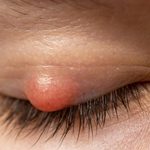Can a Chalazion Go Away on Its Own, or Does It Need Treatment