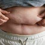 How a Tummy Tuck Can Support an Active Lifestyle in Your 60s