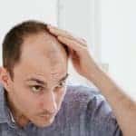 What I Wish Someone Told Me Before I Chose a Hair Transplant