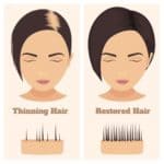Black Alopecia Hair Restoration