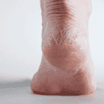 a picture of a foot with peeling heel very dry skin