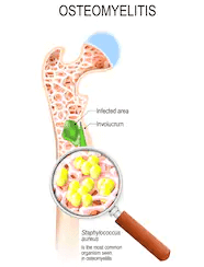 Catatan Ortopedi (Salter) – Infeksi Part 1 – Osteomyelitis (hematogenous) Akut