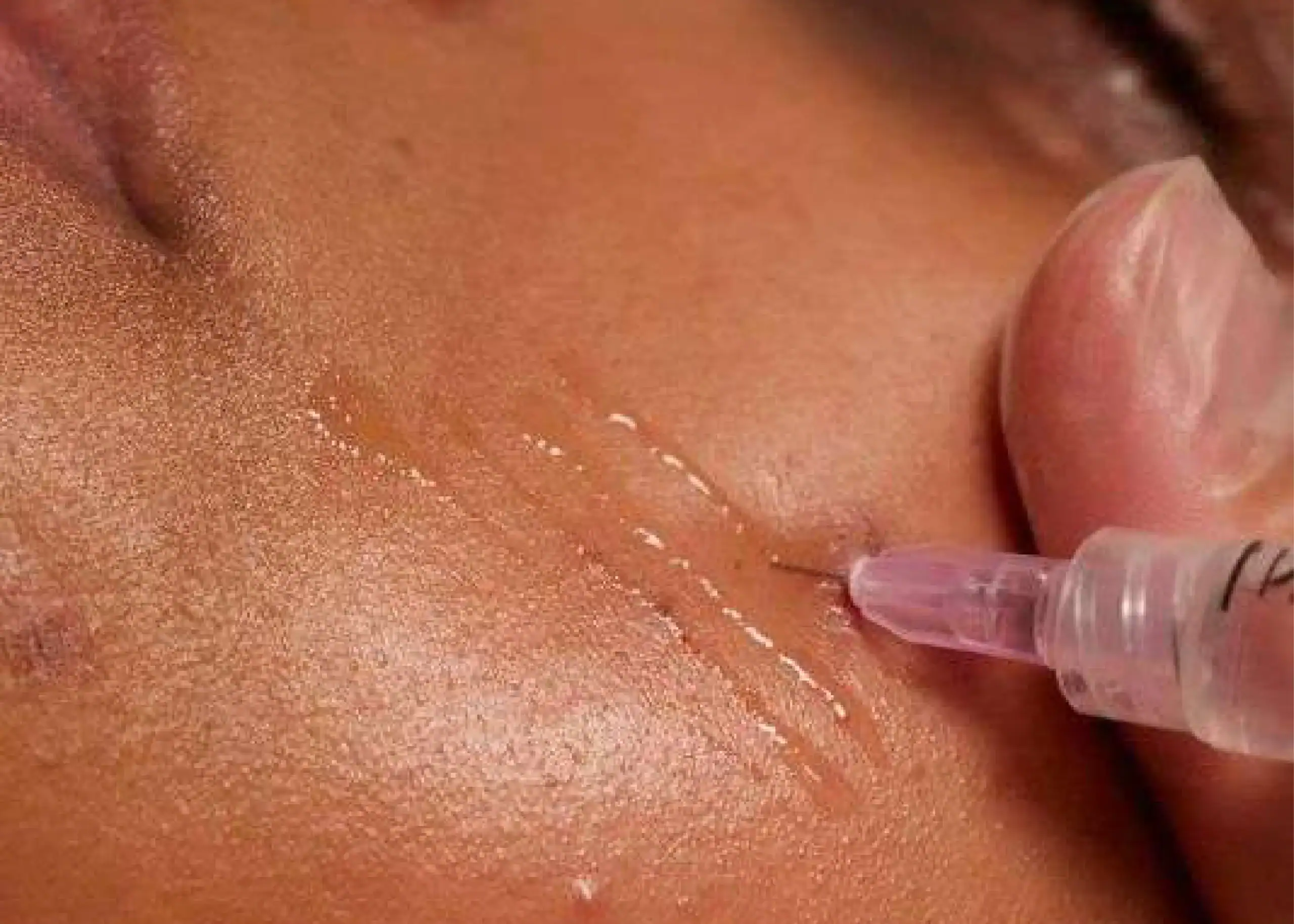 Inyección de ácido hialurónico para rejuvenecimiento facial.