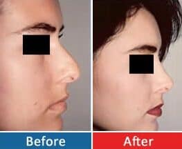Rhinoplasty,Nasal Surgery Rhinoplasty, Female & Male Rhinoplasty nasal2 (1)