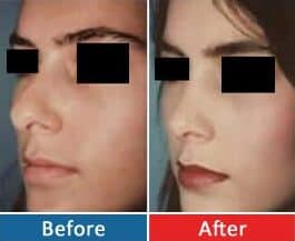 Rhinoplasty,Nasal Surgery Rhinoplasty, Female & Male Rhinoplasty nasal1 (1)