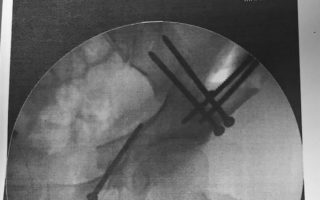 Triple-Osteotomie Röntgenbild 5 Schrauben