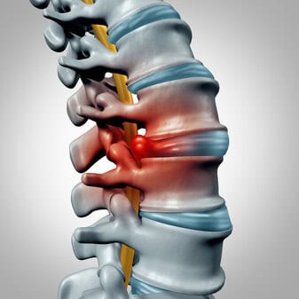 Degenerative Disc Disease