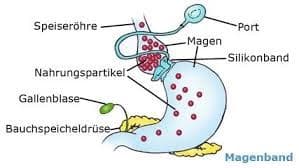 Magenring