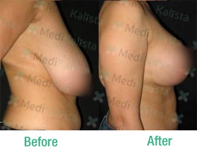 breast lift with implants