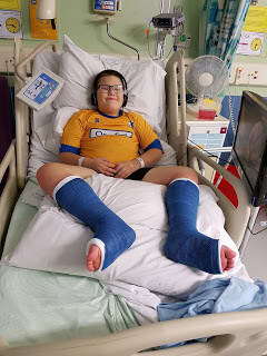 A boy lying on a bed with both legs in casts
