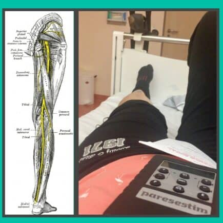 Fußheberschwäche Erfahrungen Titelbild