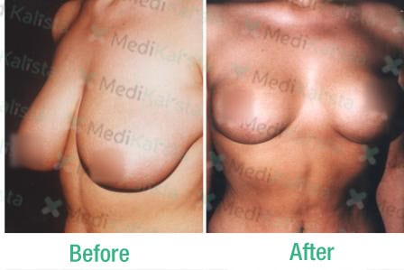 breast lift with implants