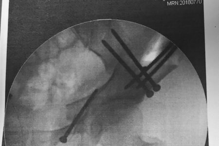 Triple-Osteotomie Röntgenbild 5 Schrauben