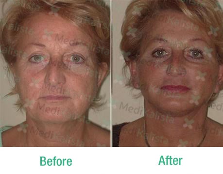 facelift