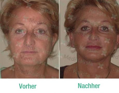 lifting cervico facial
