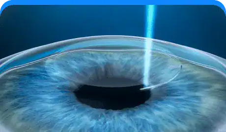 Laser Cataract Surgery 2.png-Eye Hospital In Pune