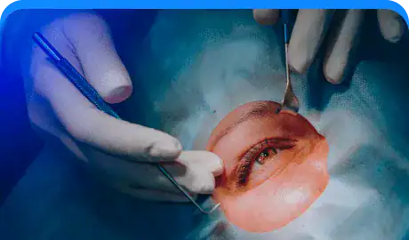 Conventional Cataract Surgery 3.png-Eye Hospital In Pune