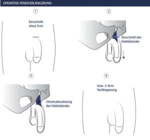 Penisplastik