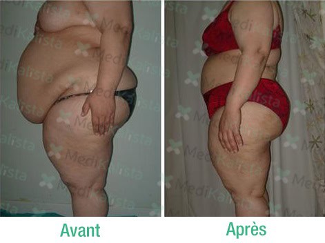 liposculpture