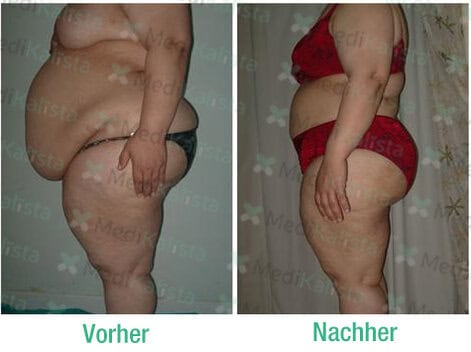 liposculpture