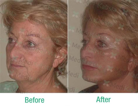 facelift