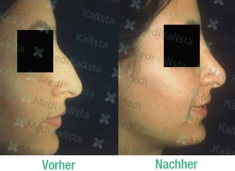 rhinoplastie