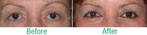 Female blepharoplasty