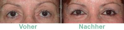 blépharoplastie
