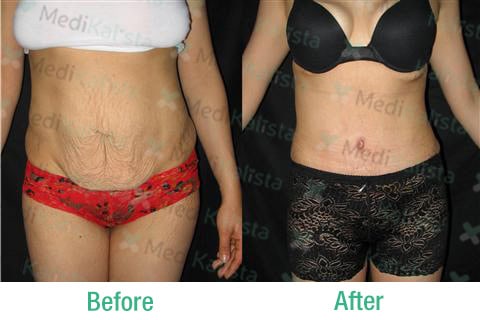 tummy tuck