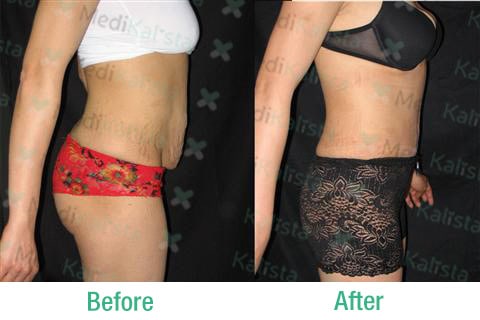 tummy tuck