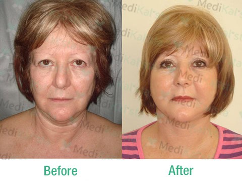 facelift