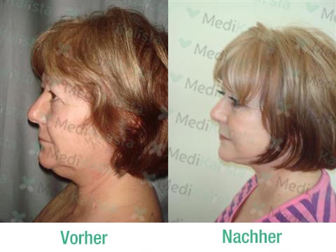 lifting cervico facial