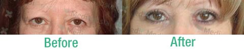 Female blepharoplasty