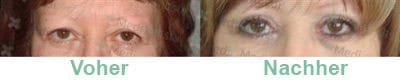 blépharoplastie avant après femme