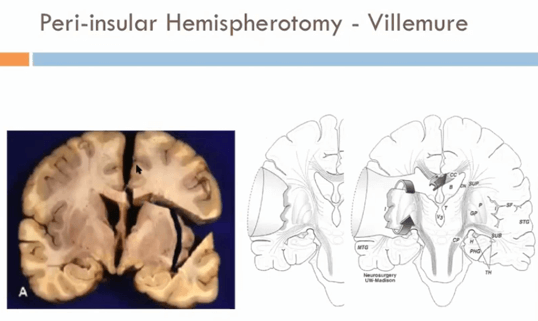Gambar 9.  Peri-insular Hemispherectomy