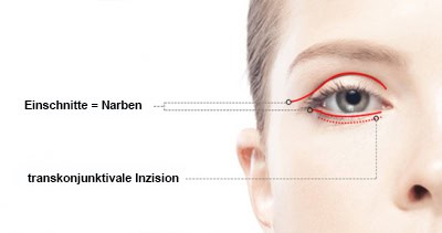blépharoplastie