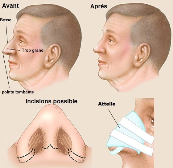rhinoplastie hommes