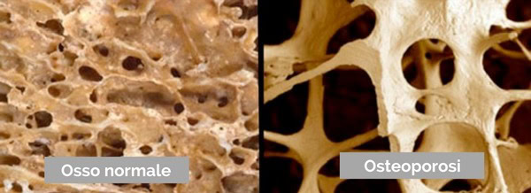 Osteoporosi osso normale osso osteoporotico