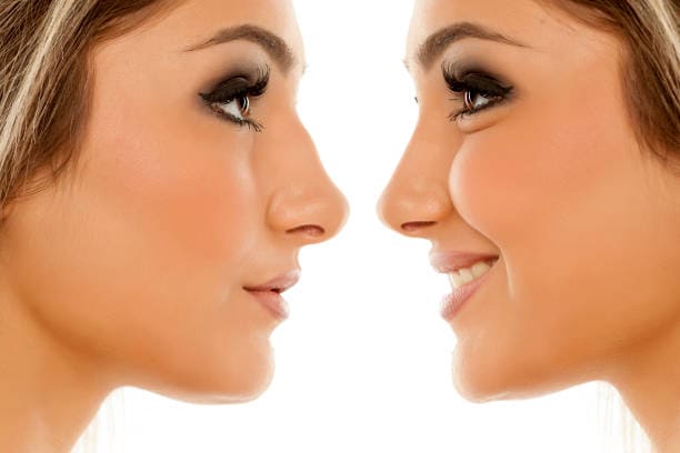 Rhinoplasty,Nasal Surgery Rhinoplasty, Female & Male Rhinoplasty Comparison of female nose, before and after plastic surgery