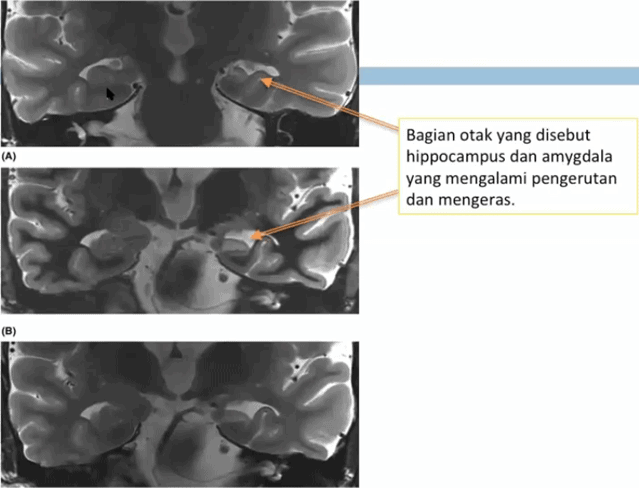 Gambar 4. MRI Hippokampal Sklerosis