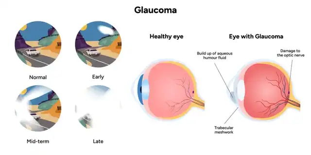 glaucoma.jpg-Eye Hospital In Pune