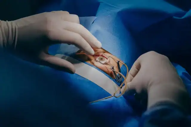 Blade-Free vs Traditional Cataract Surgery: What’s Safer for You in 2025?