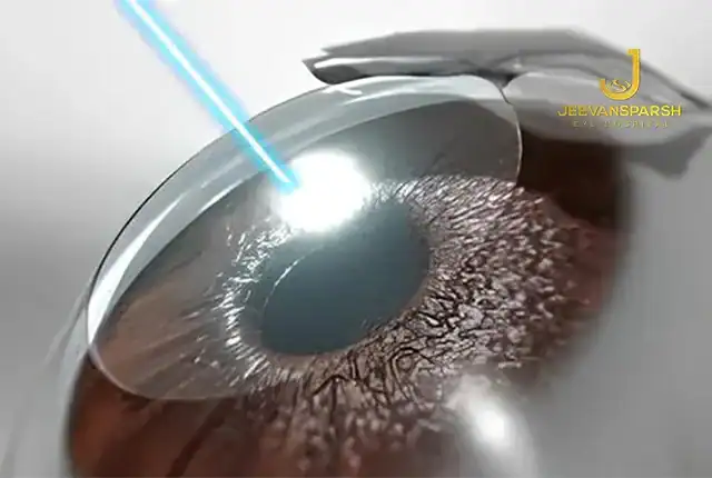 Success rate of lasik eye surgery in India: How Safe Is Eye Surgery In 2026?