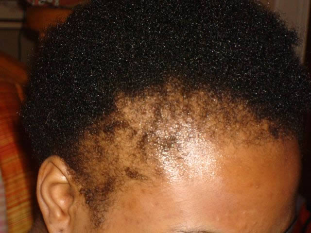 traction_alopecia1