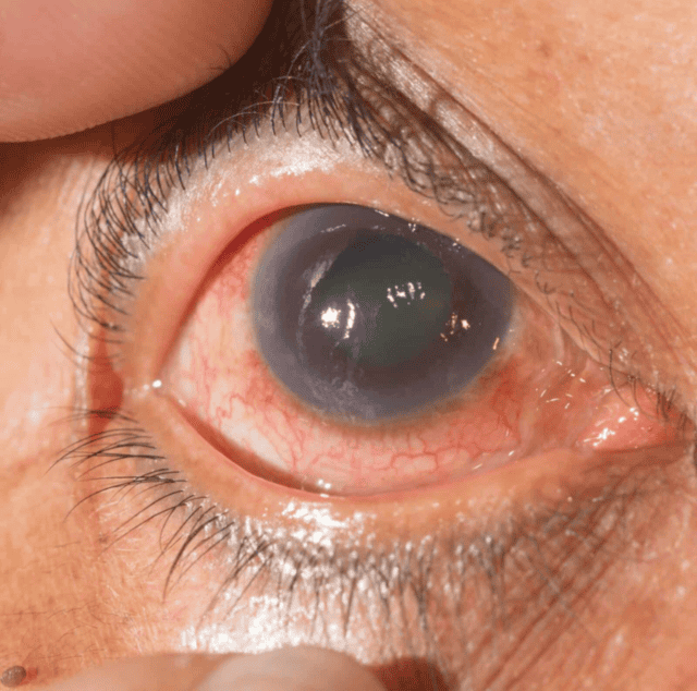 glaucoma e1719914414811-Eye Hospital In Pune